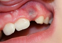 black and blue gums during teething