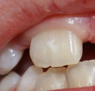 white spots on top of teeth