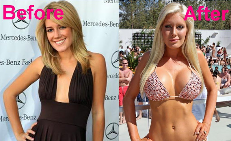 heidi montag before and after people. pictures pictures heidi montag