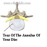 Often times a tear of the