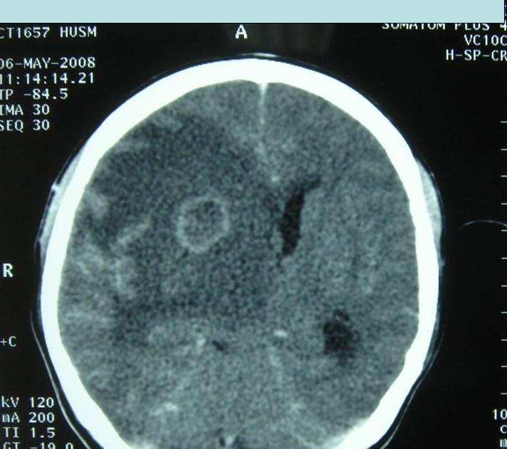 Emergency Medicine Blog Ring Enhancement Lesions on CT