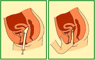 التشنج المهبلي Vaginismus تلقي ت العيادة النسائية الإستشاري د هيثم ابراهيم حسن Facebook