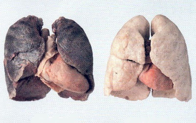 Muerte Silenciosa Pulmon+sano+y+pulm%C3%B3n+de+fumador