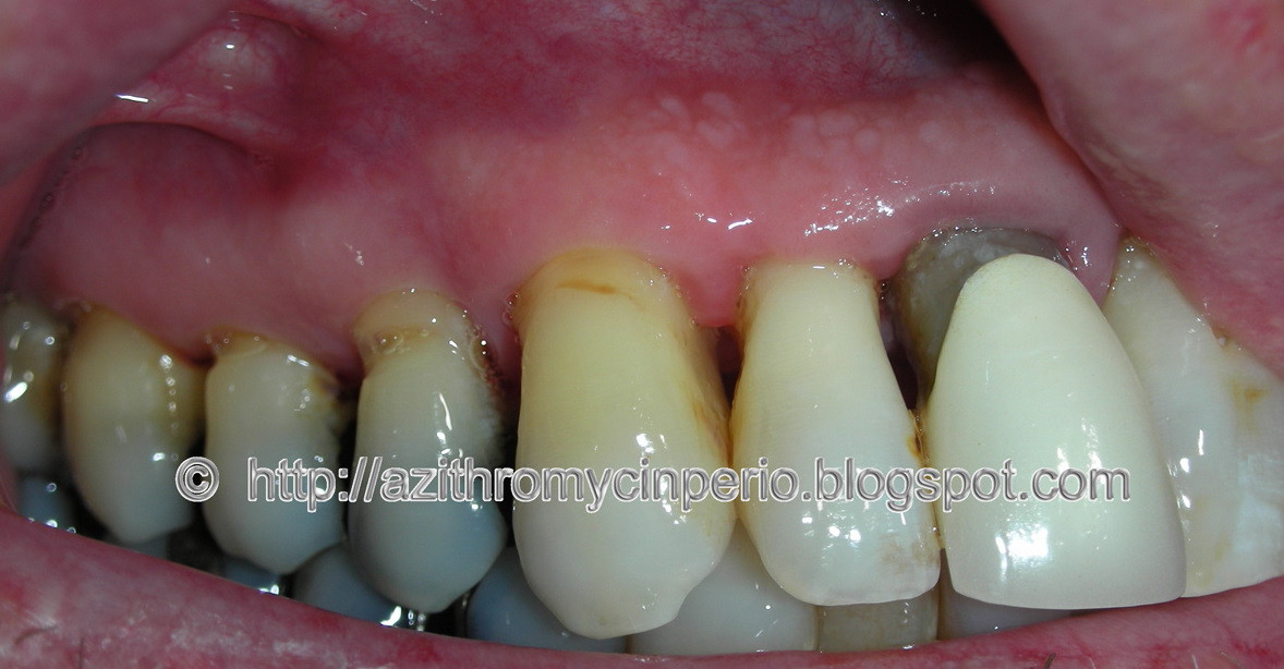 can azithromycin help tooth infection