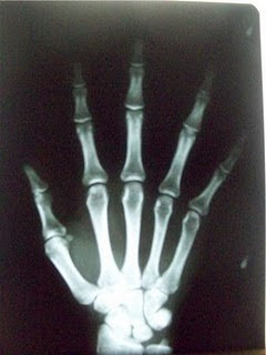 ---RAYOS X 2010--- =): MANO PROYECCION P.A- articulaciones