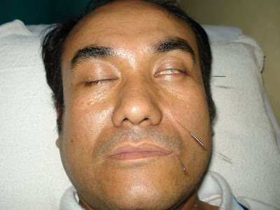 palsy bell acupunture treatment peripheral paralysis facial condition seen remarks