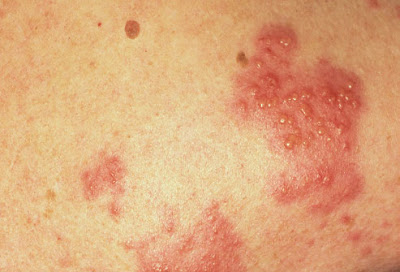 Topical steroids for hives