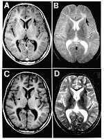 T1 and T2 weighted MRI scans