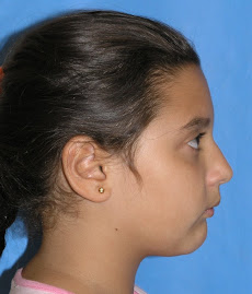 CAMBIOS FACIALES CON ORTODONCIA