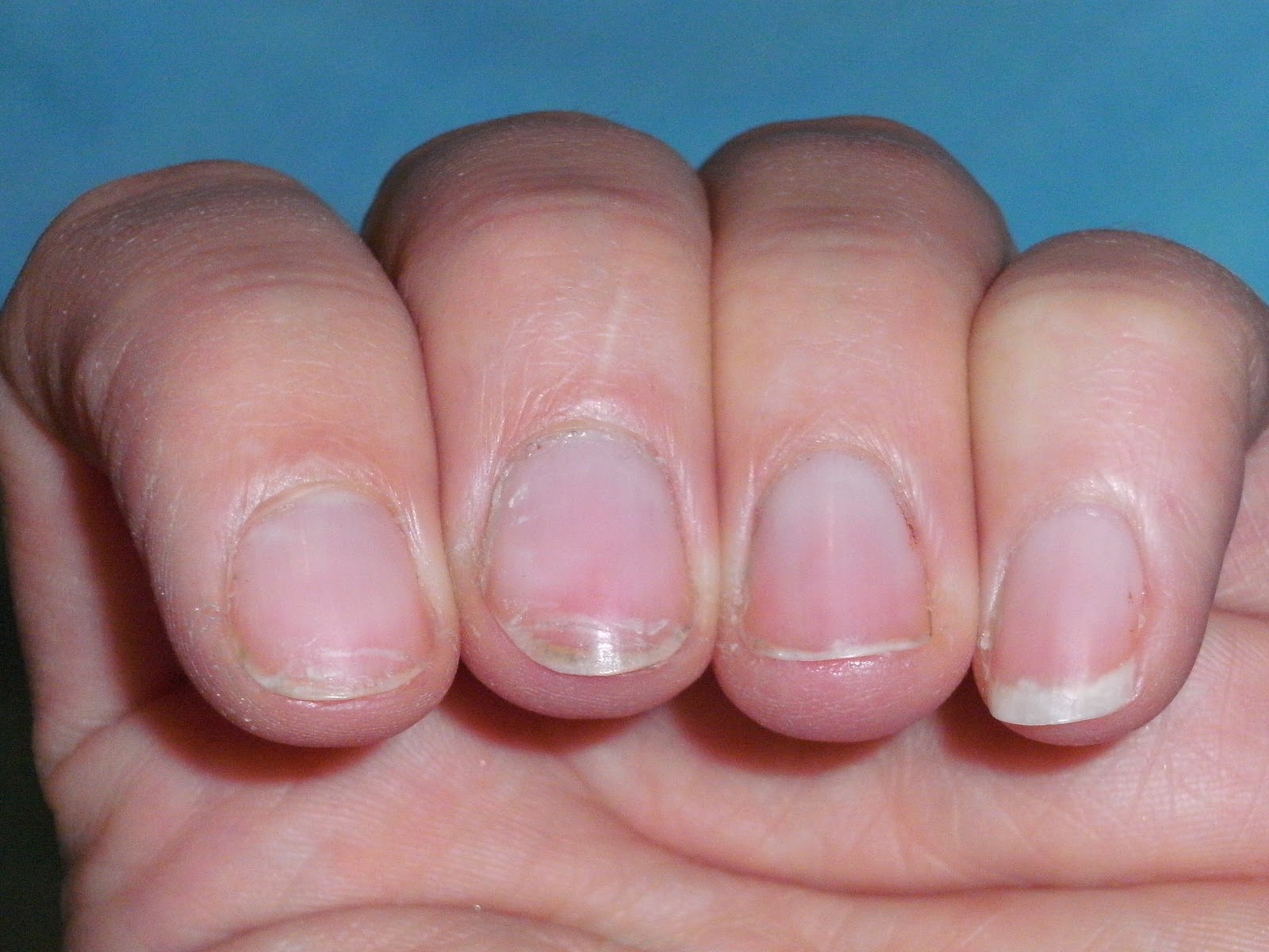 Pleasureflush Mission Nail Rescue Part One You Can See What Bad Shape The Nails Are On My Index And Middle Fingers Especially Thumbs Same Too Skin Around Them Is Horribly Dry