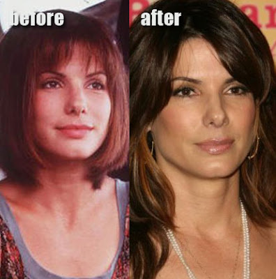 Sandra Bullock Plastic Surgery on Sandra Bullock Before And After Cosmetic Surgery