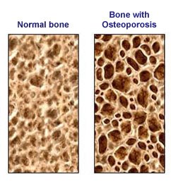 [bone-loss.jpg]