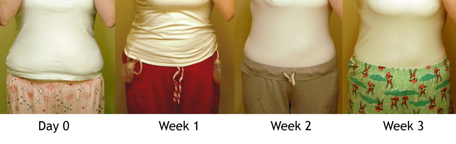first day day by day tummy tuck recovery first day day by day tummy tuck recovery