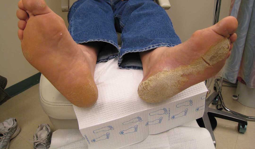 VIRTUAL GRAND ROUNDS IN DERMATOLOGY 2.0 Unusual Keratoderma