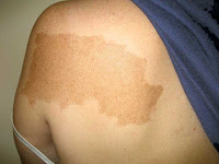 Large Patch Of Discoloration On Skin
