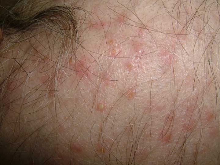 VIRTUAL GRAND ROUNDS IN DERMATOLOGY 2.0 Scalp Folliculitis in a