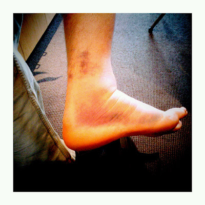 Sprained-Ankle-Bruise