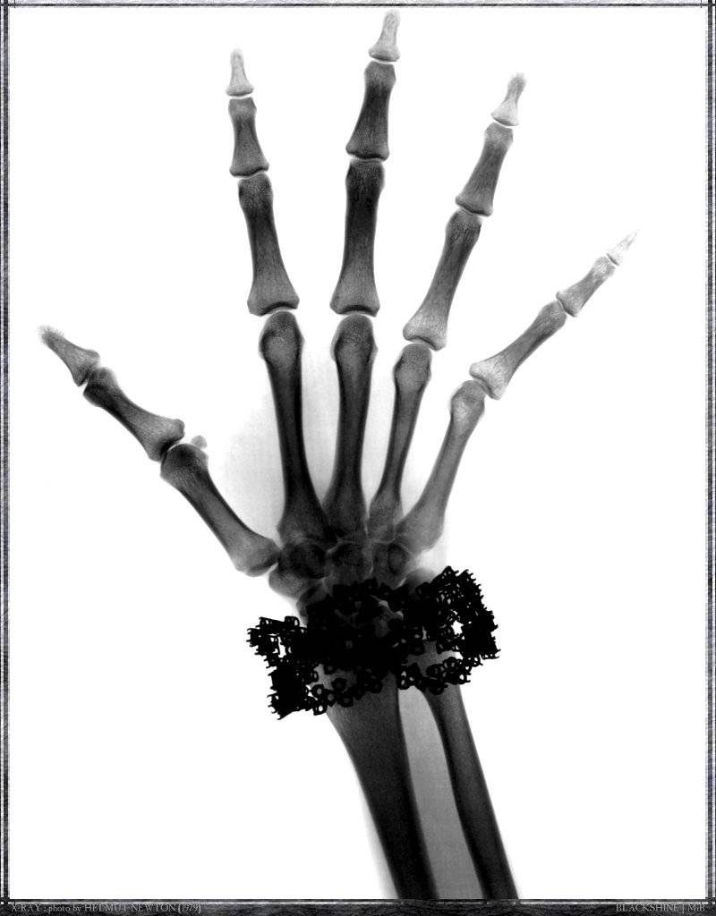 [blk-hnw071-x-ray-hand.jpg]