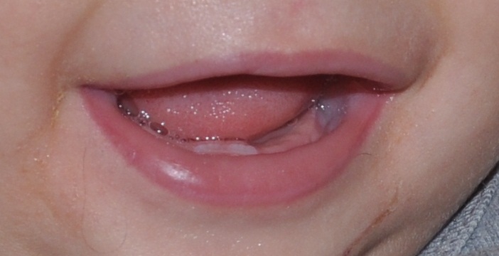 ��çokoprenses�� zorlu süreç diş çıkarma