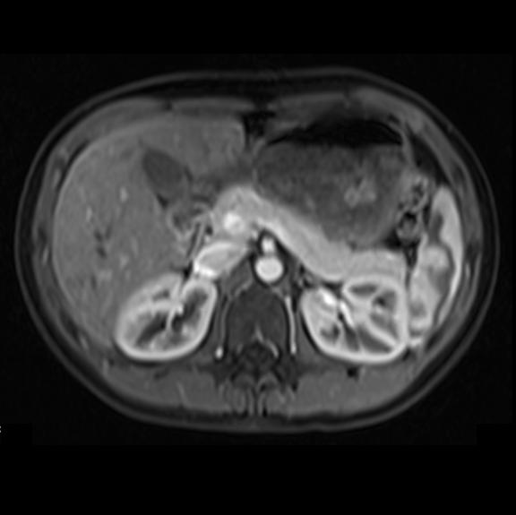 MRI Protocols MRI technique for pancreatic tumors