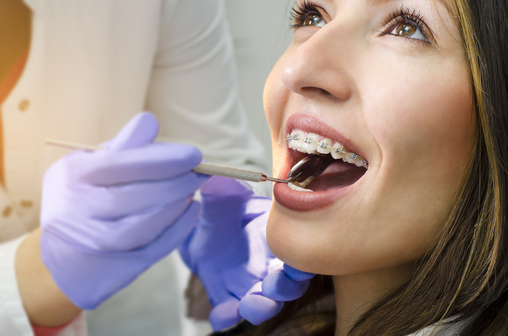 Access Dental How to Properly Clean Your Teeth with Braces
