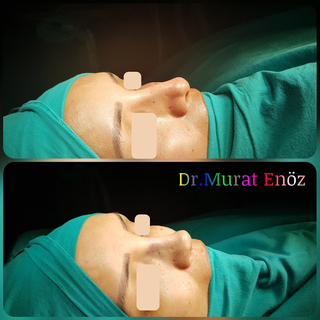 Thick Skinned Secondary Revision Rhinoplasty With Micromotor System