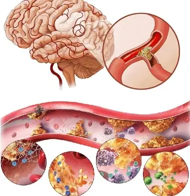 Carotid Plaque, Atherosclerosis and Stroke Carotid Plaque, Atherosclerosis and Stroke