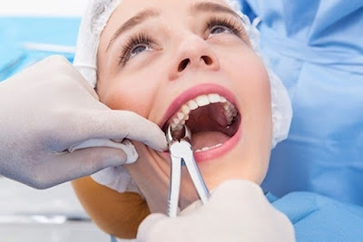 Bị sâu răng hàm trên nhổ có nguy hiểm không?-2