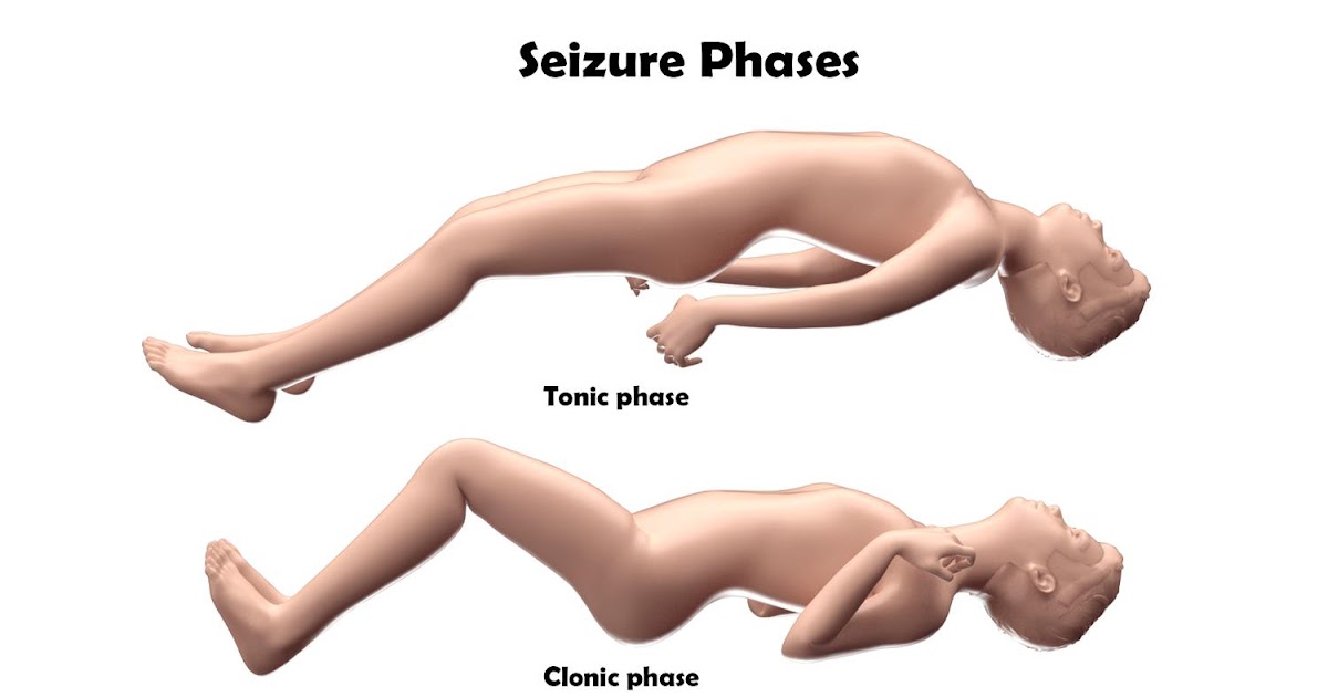 Seizure Causes What does a seizure look like?