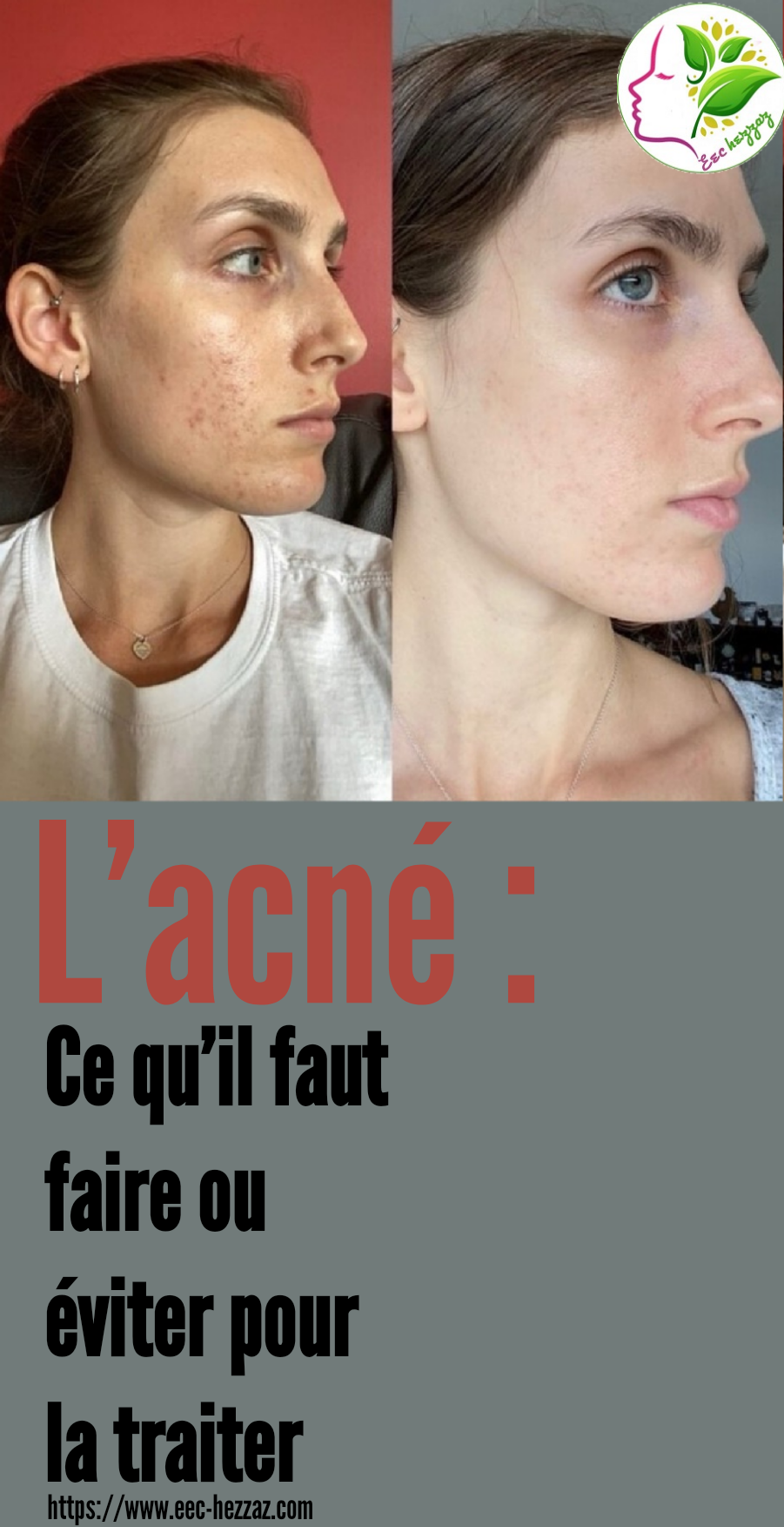 L’acné : Ce qu’il faut faire ou éviter pour la traiter