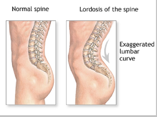 Lardosis (melengkungnya tulang belakang ke depan