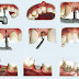 Trồng răng implant khoảng bao lâu?