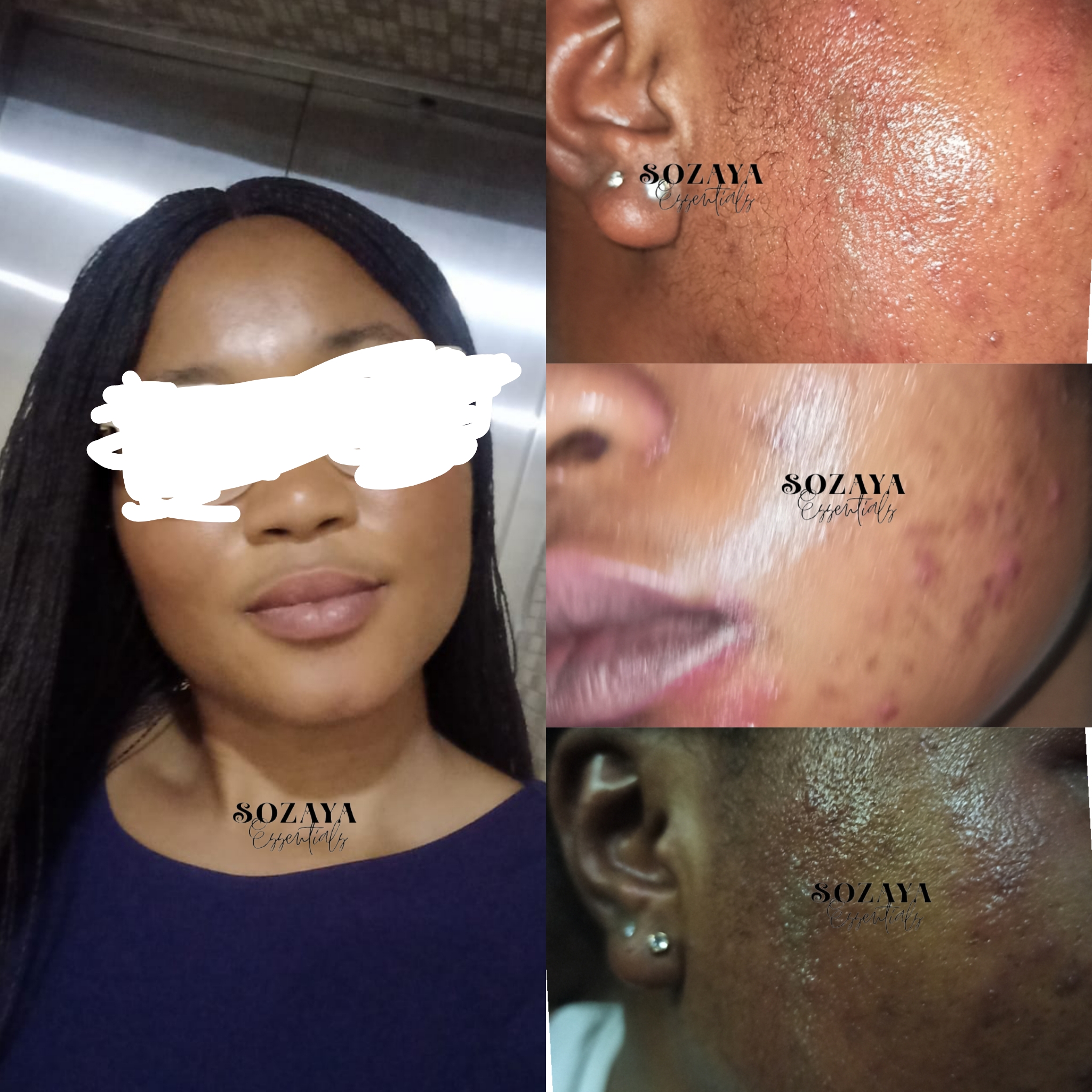 HOW TO REPAIR BLEACHED SKIN SOZAYA