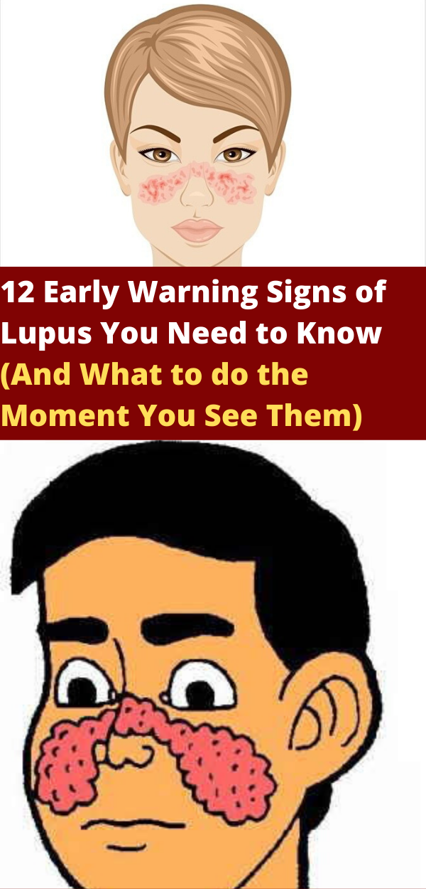 12 Early Warning Signs of Lupus You Need to Know (And What to do the