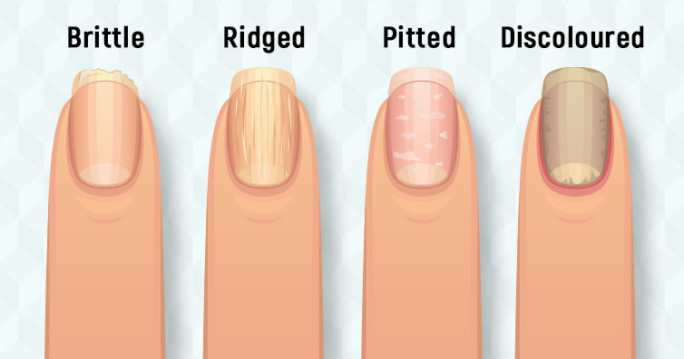 8 Health Problems That Your Nails Reveal
