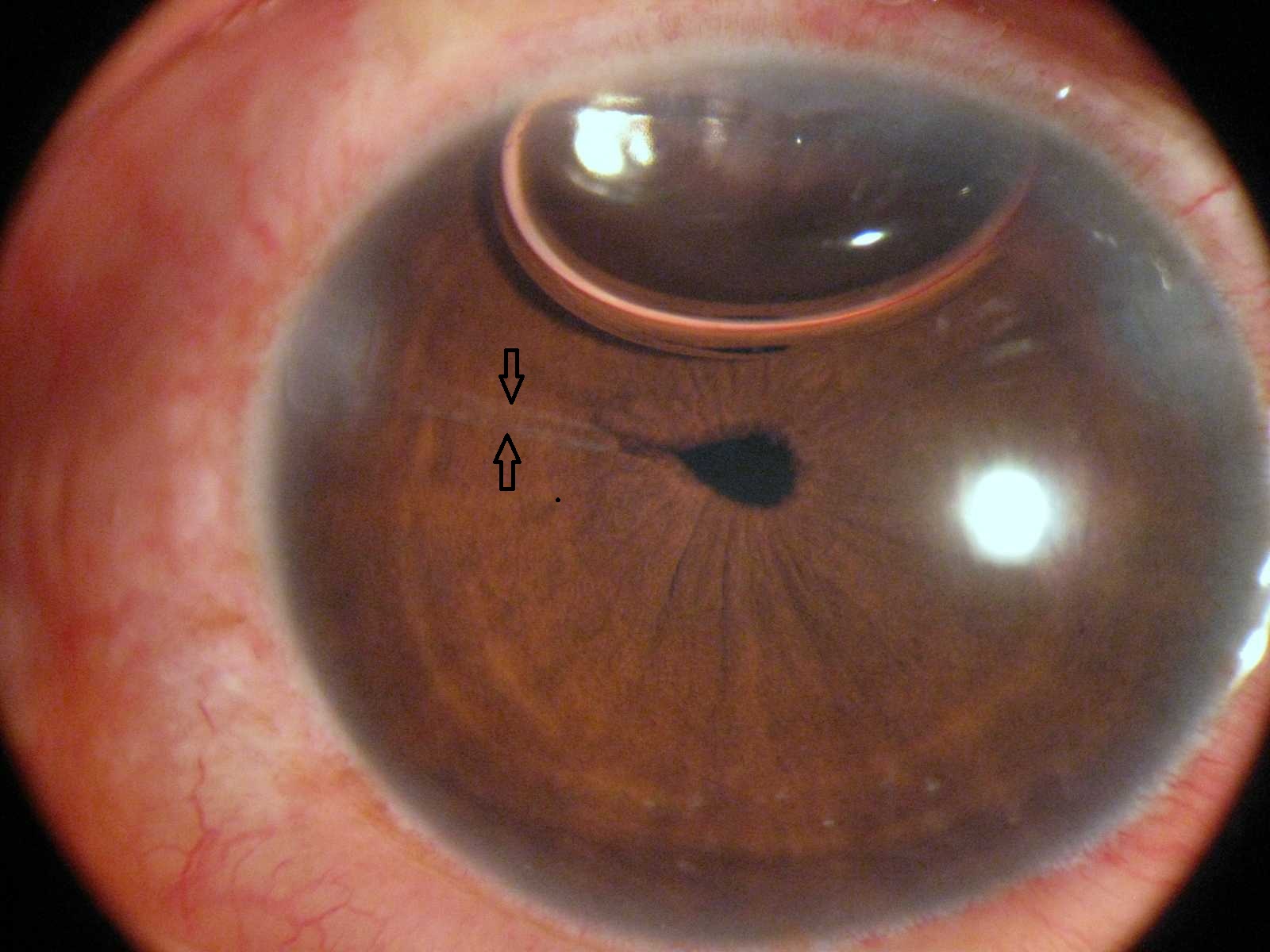 For Optometrist Vitreous band after cataract surgery