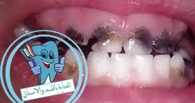 انواع تسوس الاسنان بالصور واعراضه ومراحله والوقاية منه