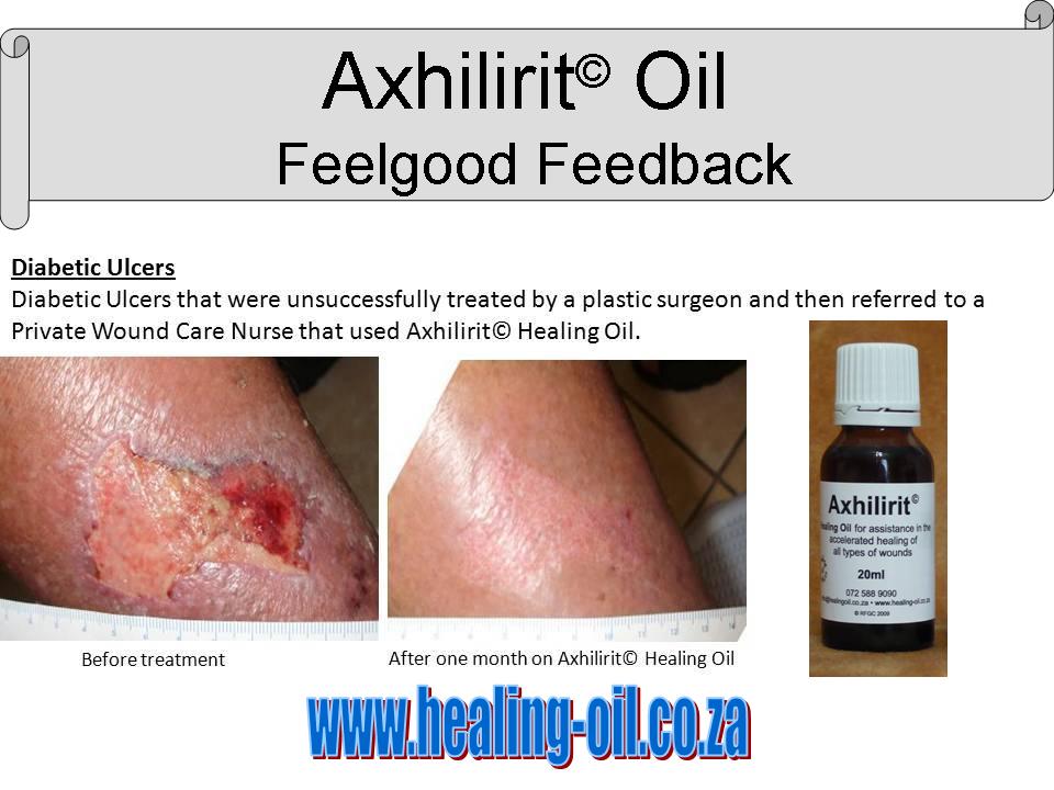 What can I use for Bed Sores, Diabetic Ulcers and Slow Healing Wounds