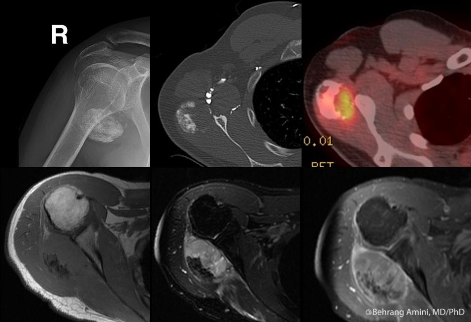 Roentgen Ray Reader Extensively Calcified Synovial