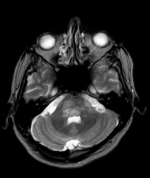 HIV SequelMRI Sumer's Radiology Blog