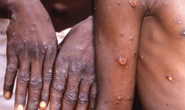 18 cases of monkey pox reported in Akwa Ibom