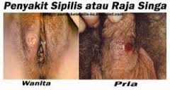 Obat Herbal Tablet Untuk Penyakit Sipilis Obat Tradisional Tablet Untuk Penyakit Sipilis
