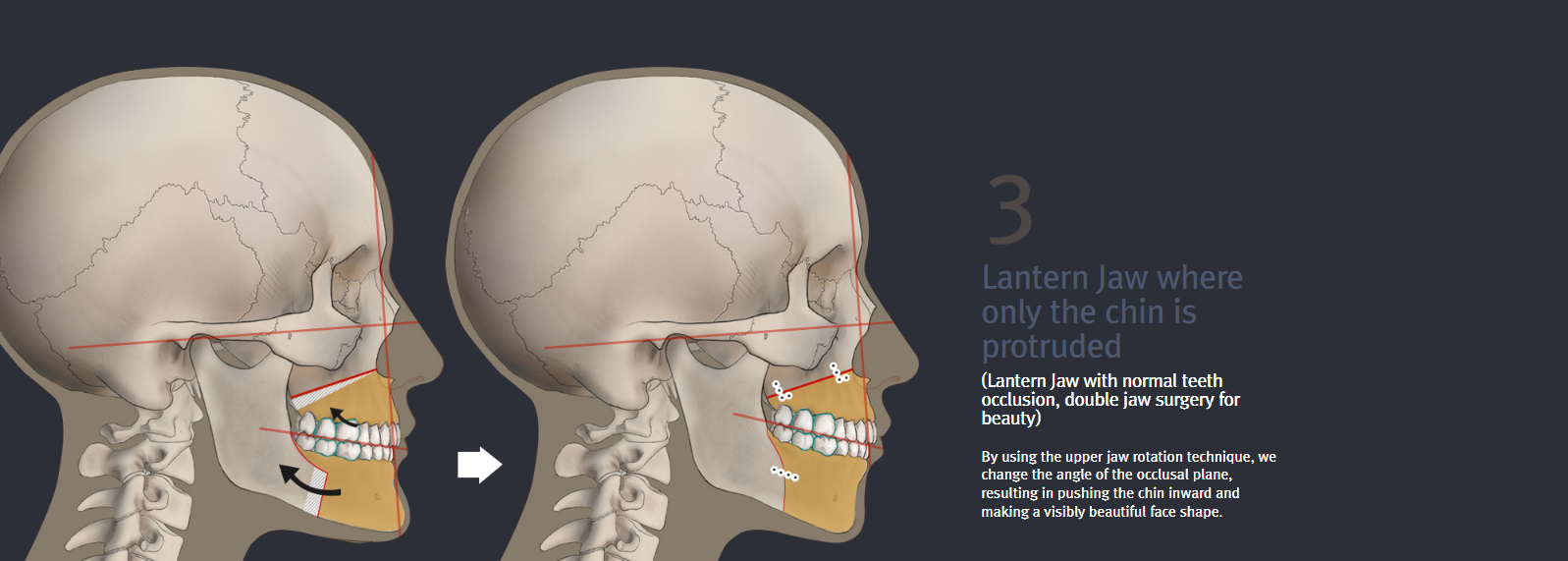 Lantern Jaw & Protruded Mouth Surgery? EUSURGERY