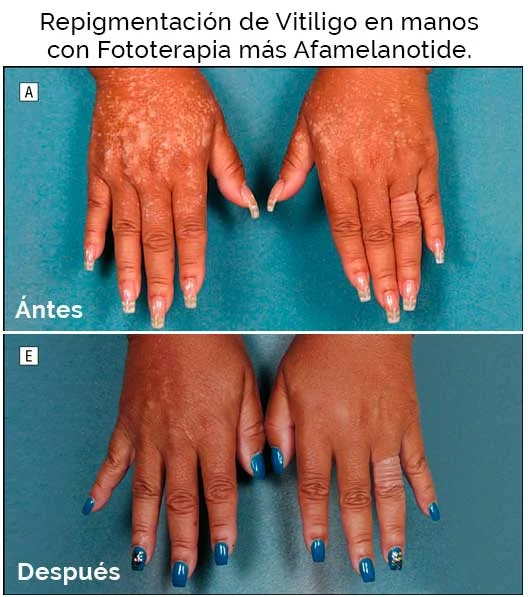 Repigmentacion-de-vitiligo-en-manos