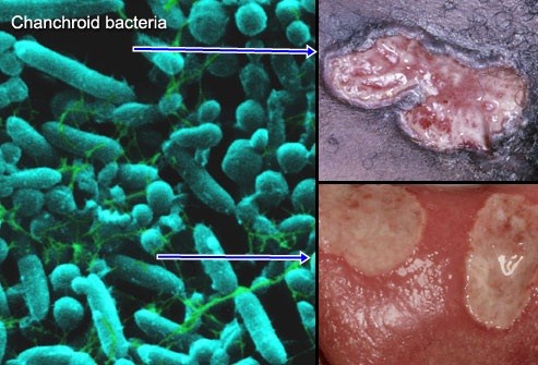 cara mengatasi sipilis dengan alami