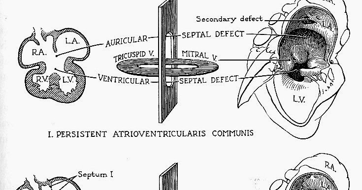 Pedi cardiology: ASD schematic diagram