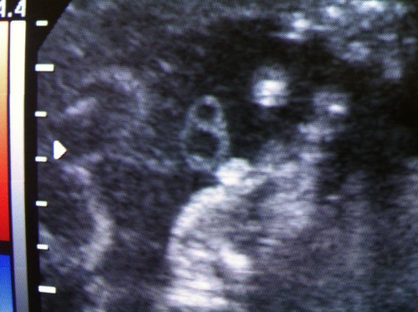 ULTRASSONOGRAFIA Dr. Walter Lustosa Jr. ARTÉRIA UMBILICAL ÚNICA