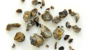 Kidney Stone Types