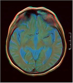 Nevit's blog: False-color Brain MRI (Motion artifacts)