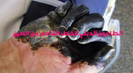 ما هي اعراض الطاعون الدبلي مرض الموت الاسود بعد انتشارة وكيفية